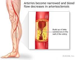 Clogged Leg Arteries can cause constant heavy legs